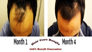 Homeopathic Medicine For Alopecia and Baldness  Hair Care Bangla [upl. by Iznekcam]