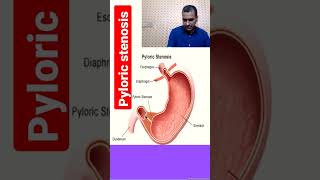 pyloric stenosis to watch full video click on link given in comments section [upl. by Melicent643]