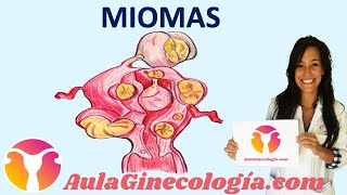 MIOMAS Síntomas diagnóstico y tratamiento de los miomas  Ginecología y Obstetricia [upl. by Sivatco480]