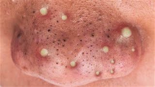 Big Cystic Acne Blackheads Extraction Blackheads amp Milia Whiteheads Removal Pimple Popping S0014 [upl. by Fasto]