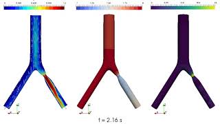 CFD Simulation of Idealised Iliac Bifurcation with Stenosis and Windkessel Outlet Boundary Condition [upl. by Yelreveb681]