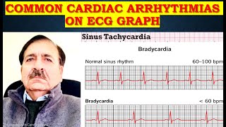 Identifying irregular heartbeat on ECG graph  Lectures by Dr Alamzeb [upl. by Nhor240]