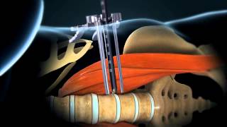 LLIF Lateral Lumbar Interbody Fusion  Larry Parker MD [upl. by Aryajay705]