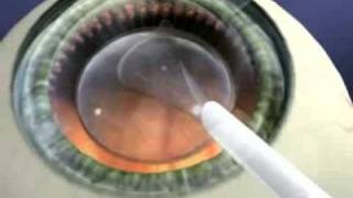 Staar Surgical Visian ICL Implantation [upl. by Kylstra]