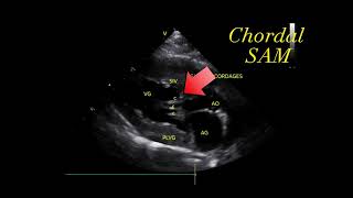 Systolic anterior motion SAM of the mitral chordae tendineae chordal SAM [upl. by Reviere]