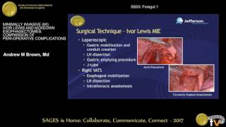 Minimally invasive Ivor Lewis amp McKeown esophagectomies Comparison of perioperative complication [upl. by Casimire]