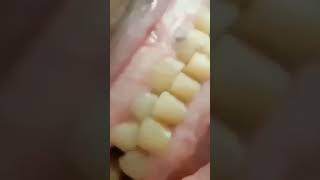 What does BRUXISM or Teeth Grinding sound like [upl. by Alol]