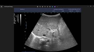 Portal vein chronic thrombosis with cavernous transformation [upl. by Asilak]