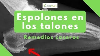 espolones en los talones remedios caseros [upl. by Anilak]