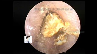 Ear wax removal Treatment of cerumen embolism [upl. by Barkley]