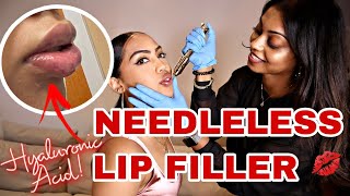 NEEDLELESS LIP FILLERS💋 [upl. by Thompson]