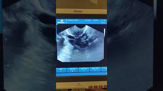 Endometrial Polyp and Ant wall interstitial myoma pregnant 39weekspregnant [upl. by Inittirb]