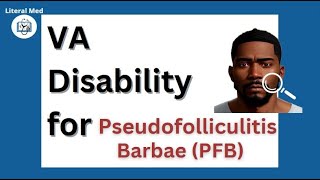 PFB Pseudofolliculitis Barbae Razor Bumps VA disability  pfb veterans vadisability nexus [upl. by Bobker]