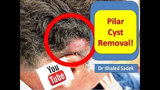 Large Pilar Cyst Removal LipomaCystcom Dr Khaled Sadek [upl. by Ativak]