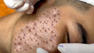 Best of Blackheads Remover [upl. by Delmar]