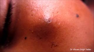 Big Infected Sebaceous Cyst Face [upl. by Anelhtac]