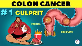 1 🔥 Cause of Colon Cancer amp how to prevent it  Colon Cancer  causes  Rectal cancer [upl. by Najtsirk]