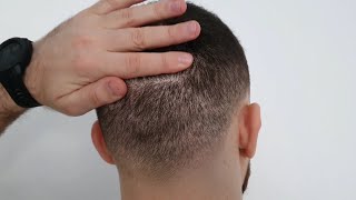 FUE Hair Transplant 8 MONTHS Results  Overharvested Donor Area [upl. by Darken]