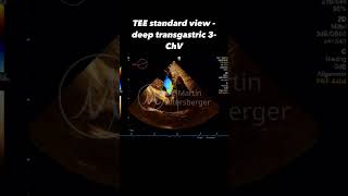 TEE standard  deep transgastric 3ChV [upl. by Suertemed]