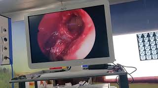 ENDOSCOPIC SINUS DEBRIDEMENT IN MUCORMYCOSIS [upl. by Rocca607]