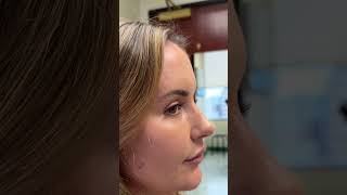 Scarless Nose Rhinoplasty bestrhinoplasty nosejob bestnosejob [upl. by Aarika61]