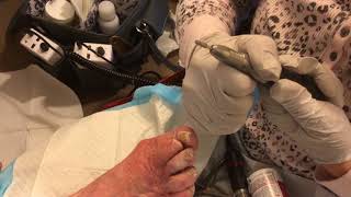 Foot Care Professional Uses Medicool ceramic bur to reduce thick fungal nails and calluses [upl. by Webster]