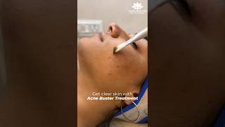 Acne Removal Treatment  acnetreatment acne acneremoval acneproneskin shortsyoutube shorts [upl. by Sidnala601]