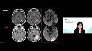 Comprehensive Brain Tumor Imaging  Soonmee Cha MD [upl. by Cima]