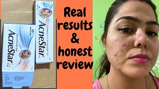 Acnestar Gel amp Acnestar soap Review amp results HOW TO GET RID OF ACNE FAST Pimples blackheads [upl. by Aserehc]