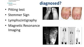 An Overview of Pediatric and Primary Lymphedema [upl. by Welsh]