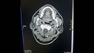 Right Cerebral venous infarct secondary to Superior sagittal sinus thrombosis [upl. by Htenay]