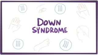 Down syndrome trisomy 21  causes symptoms diagnosis amp pathology [upl. by Duester]