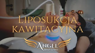 Liposukcja kawitacyjna – Liposukcja Bez Skalpela w salonach Angel Beauty amp Nails [upl. by Concepcion]