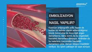 Embolizasyon yöntemi nedir Radyoembolizasyon tedavisi nedir nasıl yapılır [upl. by Thoma]