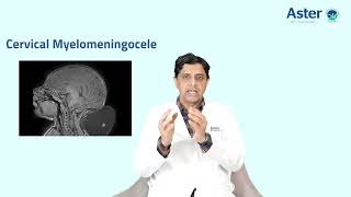 Cervical Myelomeningocele  Dr Dhananjaya I Bhat  Neurology  Aster RV [upl. by Dirgis]