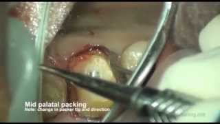 Gingival Retraction methods [upl. by Egidio]