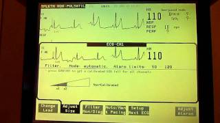 3leads ECG [upl. by Cordalia]