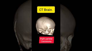 Ct brain Craniotomy Hydrocephalus ctbrain ctscan hydrocephalus craniotomy vp shunt brain [upl. by Yrrot]