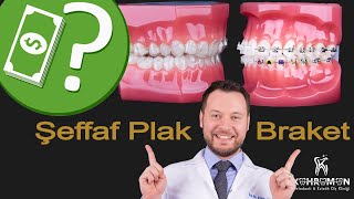 Fiyat Karşılaştırması Invisalign Şeffaf Plak Tedavisi vs Diş Teli  Braket  ile Ortodontik Tedavi [upl. by Cly]