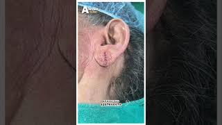 Ear Piercing Before amp After See the Difference Awish Clinic [upl. by Frentz]