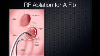 Pulmonary Vein Ablation Cardiac CT [upl. by Phelps]