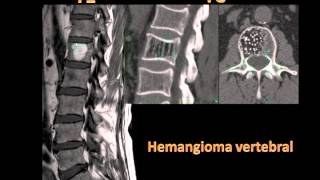 Tratamiento hernia discal L5S1  Fisioterapia y osteopatía Bilbao [upl. by Amehsat]