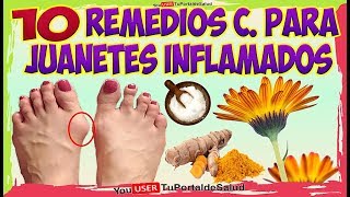 COMO ELIMINAR LOS JUANETES con Estos 10 Remedios Caseros Para los JUANETES INFLAMADOS [upl. by Dohsar]