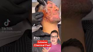 Shocking CHEMICAL PEEL  Next Level Phenol Peel shorts [upl. by Alicirp]