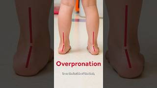 🚩These red flags could be indicators for pronation in your childs feet🚩 shorts [upl. by Jorge]