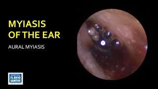 MYIASIS OF THE EAR [upl. by Gillead93]