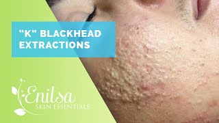 Blackheads Whiteheads Extractions on quotKquot Part 1 [upl. by Legyn]