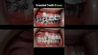 40 months for this braces Crowded teeth braces orthodontist dentist dentistry [upl. by Steiner]