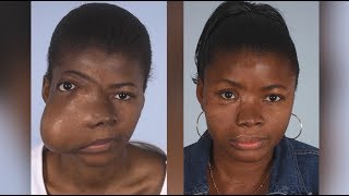 Maxillofacial Surgery Changing Faces Changing Lives  Kadiatus Story [upl. by Livvi118]