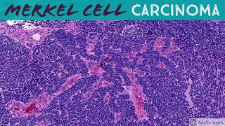 Merkel Cell Carcinoma weird palisading spindle cell morphology  Dermpath Dermatology Pathology [upl. by Sadnac]